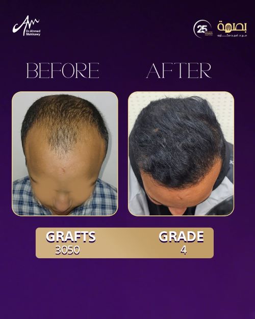 افضل تقنيات زراعة الشعر